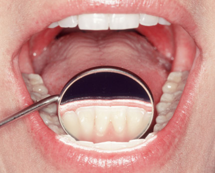 Một số vấn đề cơ bản về lấy cao răng và đánh bóng răng tại Nha Khoa Thùy Anh Thái Nguyên